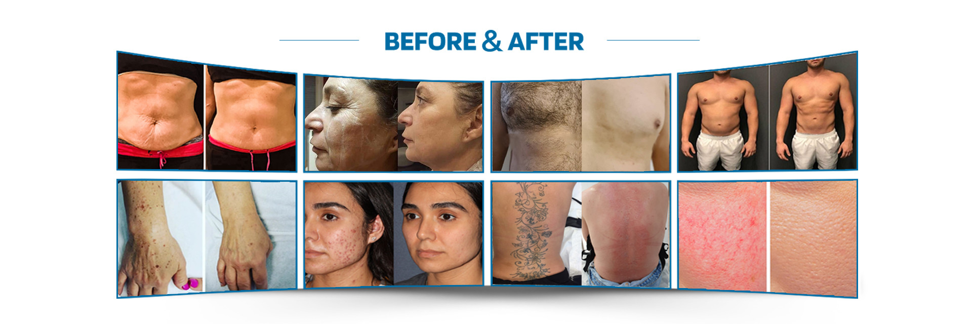 qualité Machine d'épilation de laser usine