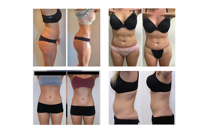 Machine de liposuccion au liposucteur 6D avec 635nm 650nm 780nm 810nm 940nm 980nm 6