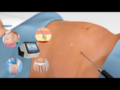 Équipement laser Lipo 30W 60W 980nm Diode Lipo machine laser pour la perte de poids